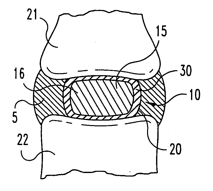 Spinal nucleus replacement implants and methods