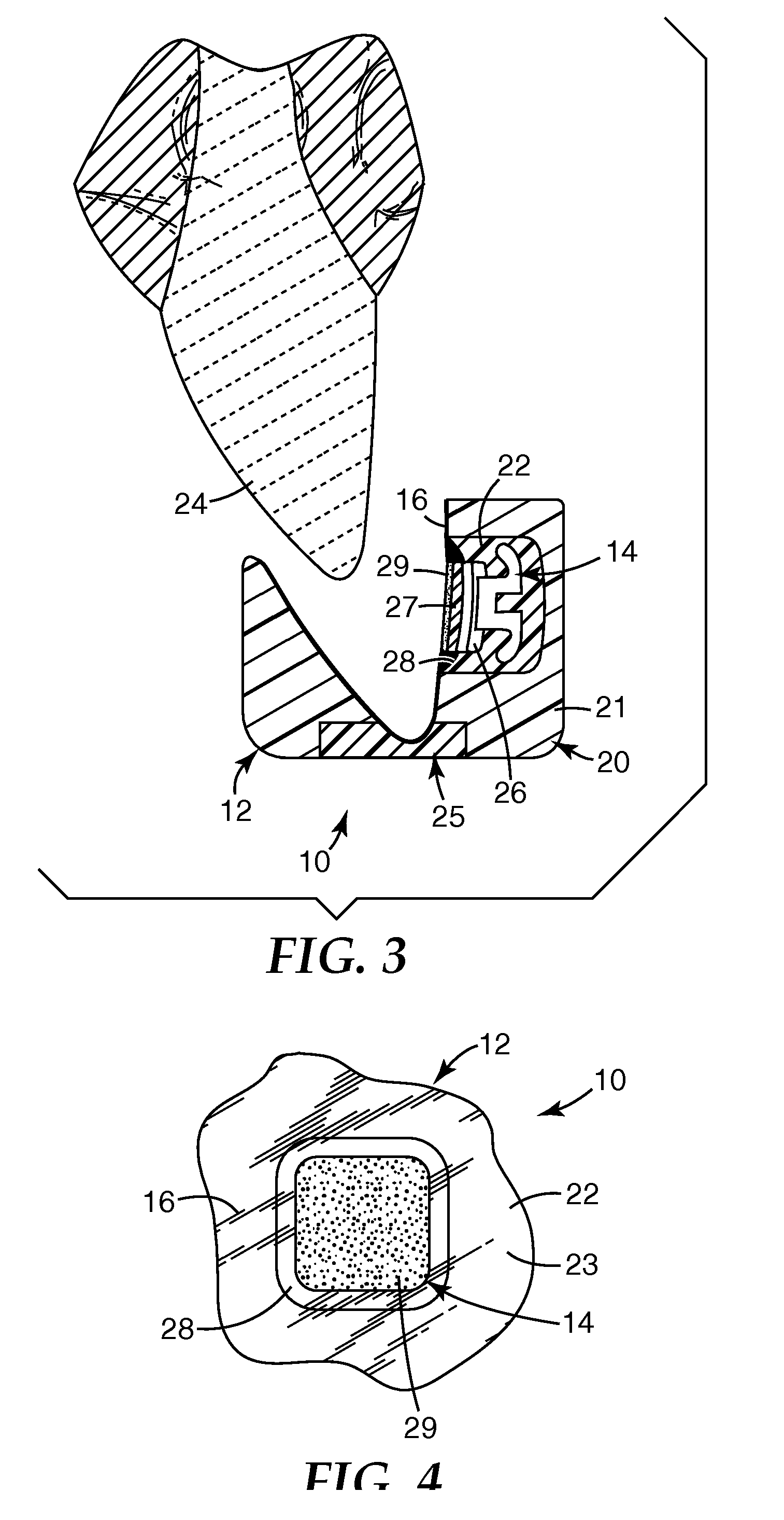 Methods and apparatus for applying dental sealant to an orthodontic patient's teeth