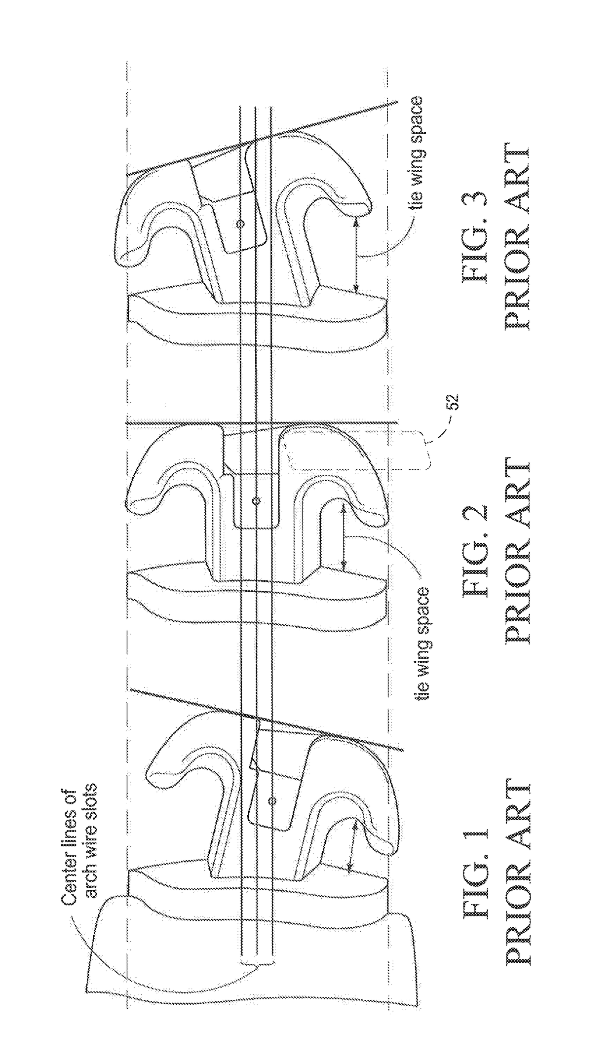 Orthodontic Bracket Apparatus and Method for Treating a Malocclusion