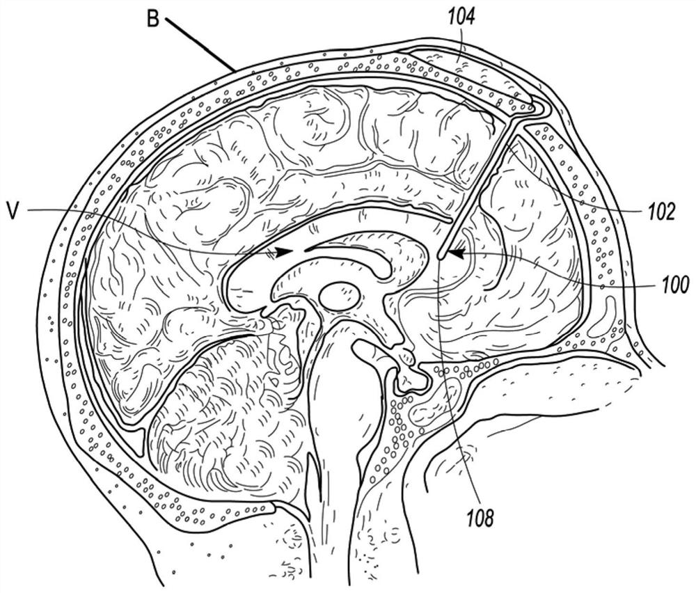 Implantable system for increasing intrathecal drug dispersion