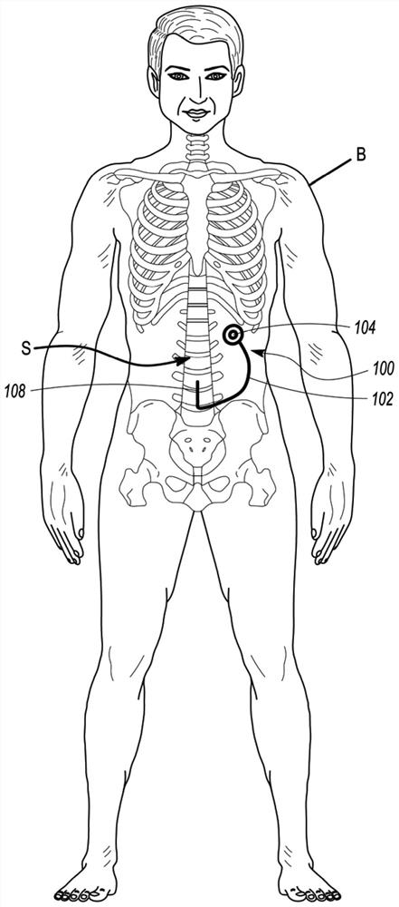 Implantable system for increasing intrathecal drug dispersion