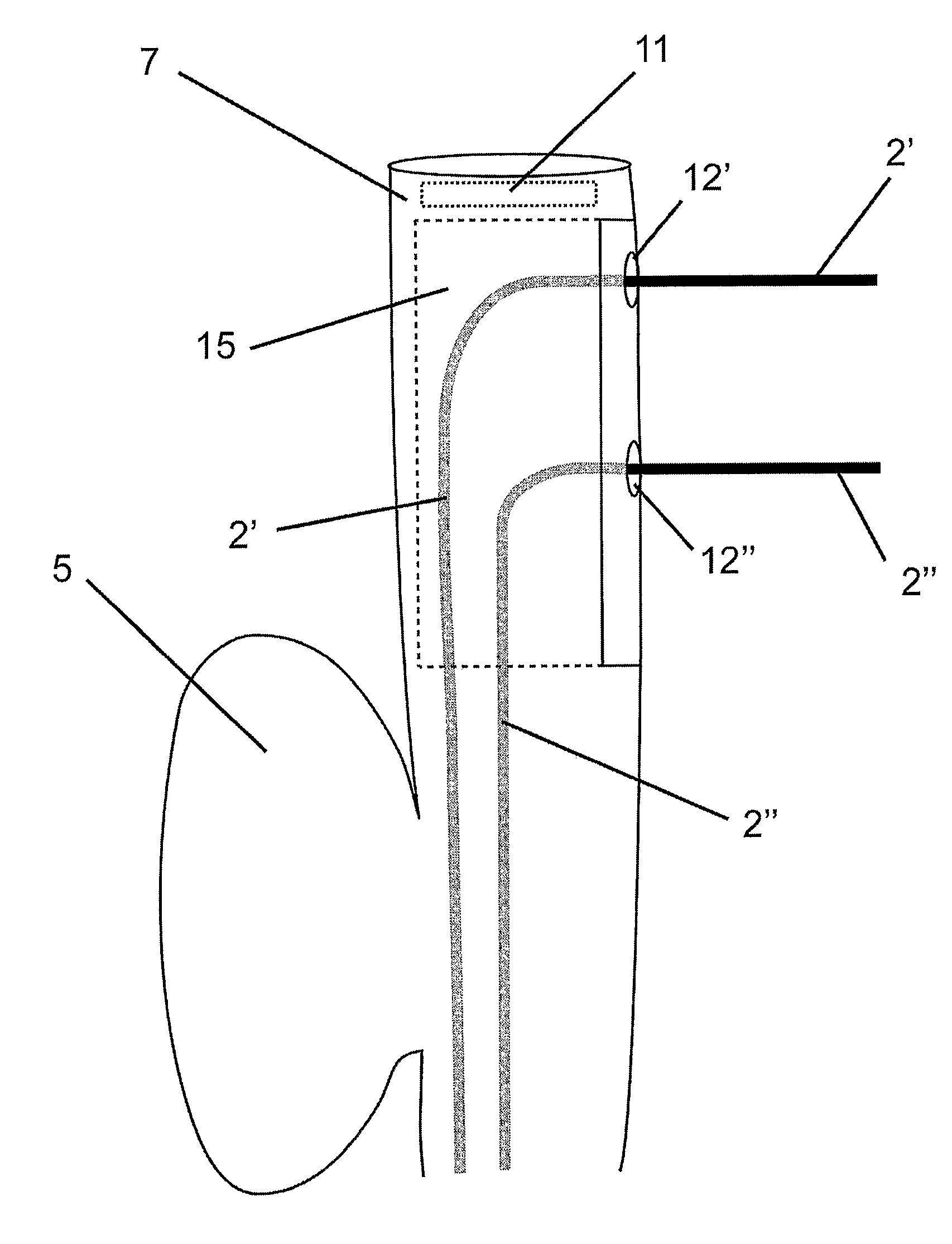 Flexible endoscope for endo luminal access radial frequency tumor ablation