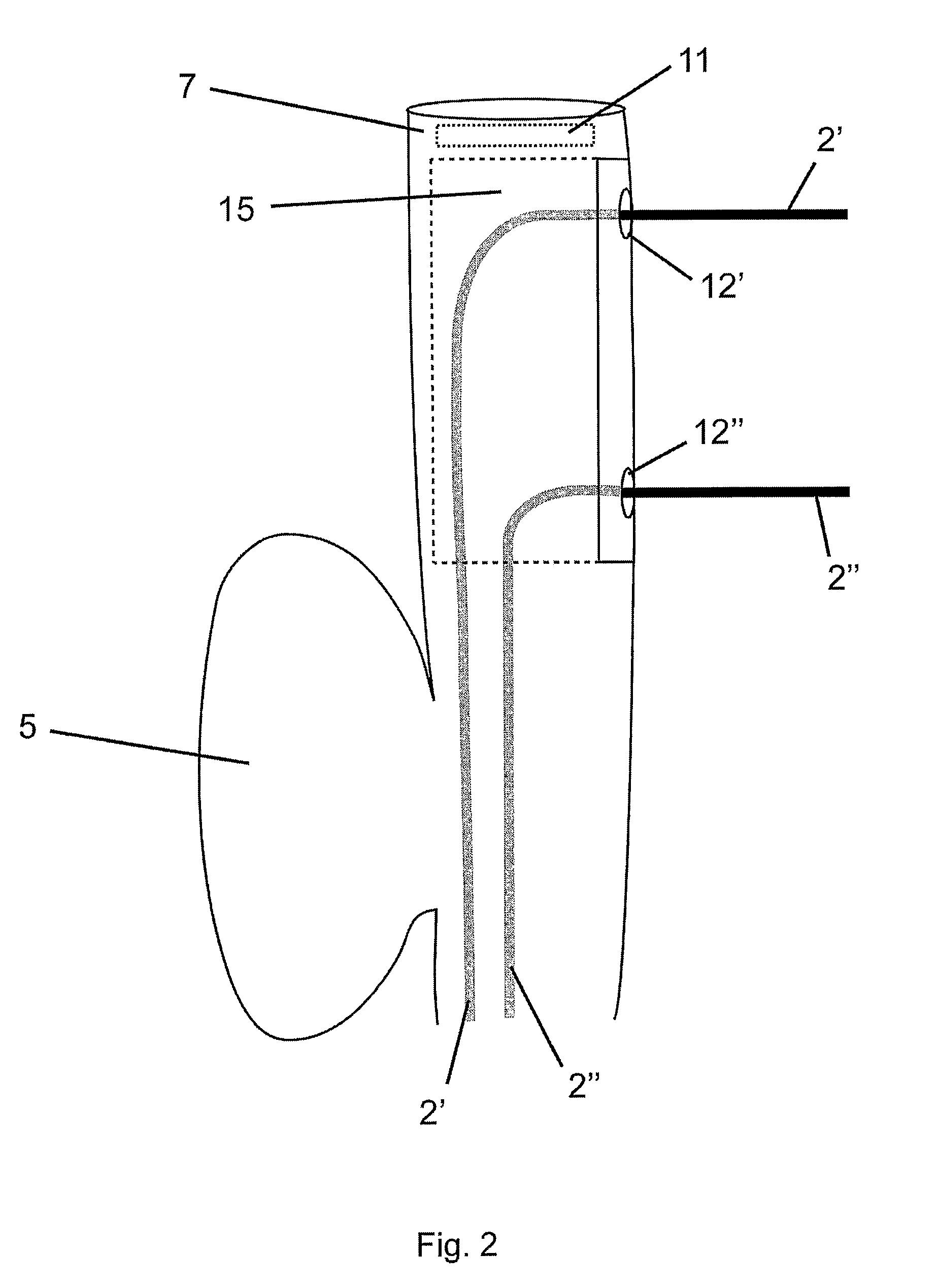 Flexible endoscope for endo luminal access radial frequency tumor ablation