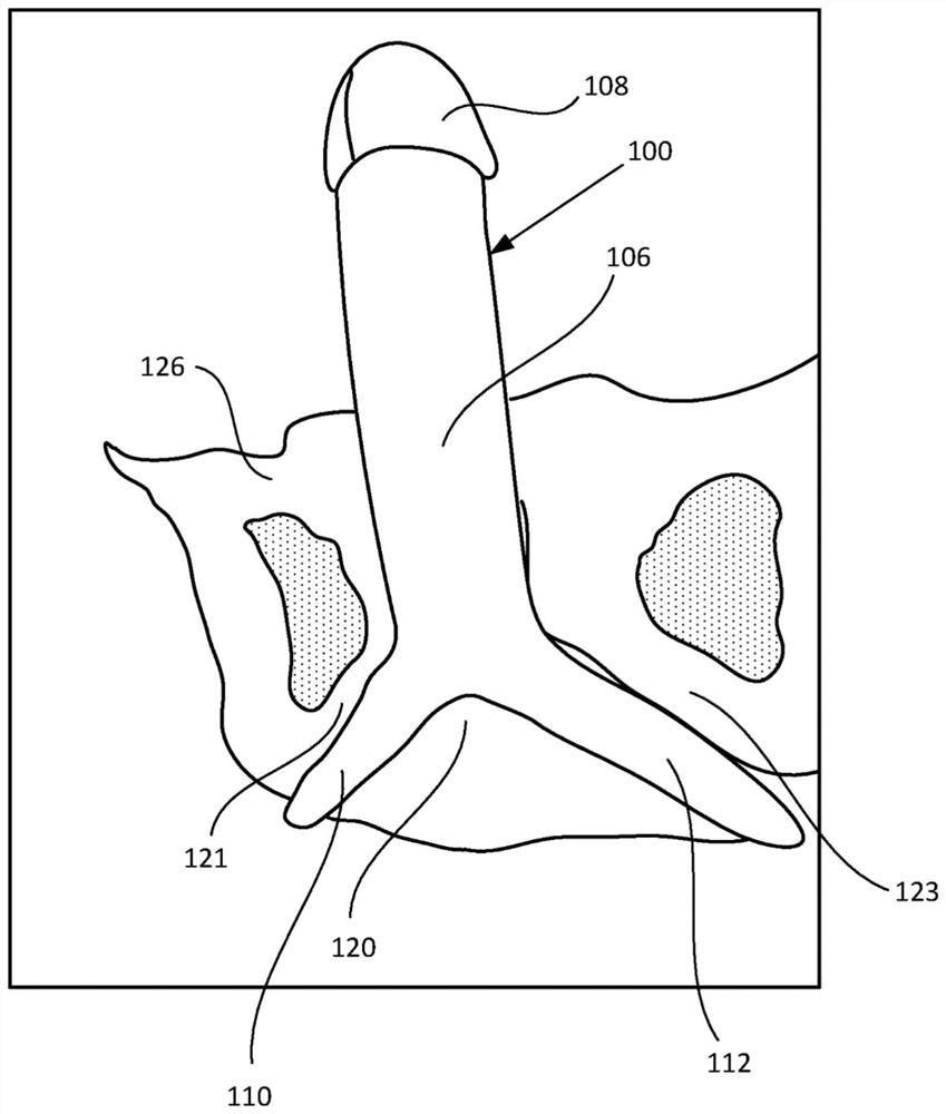 Penile implant for neophallus