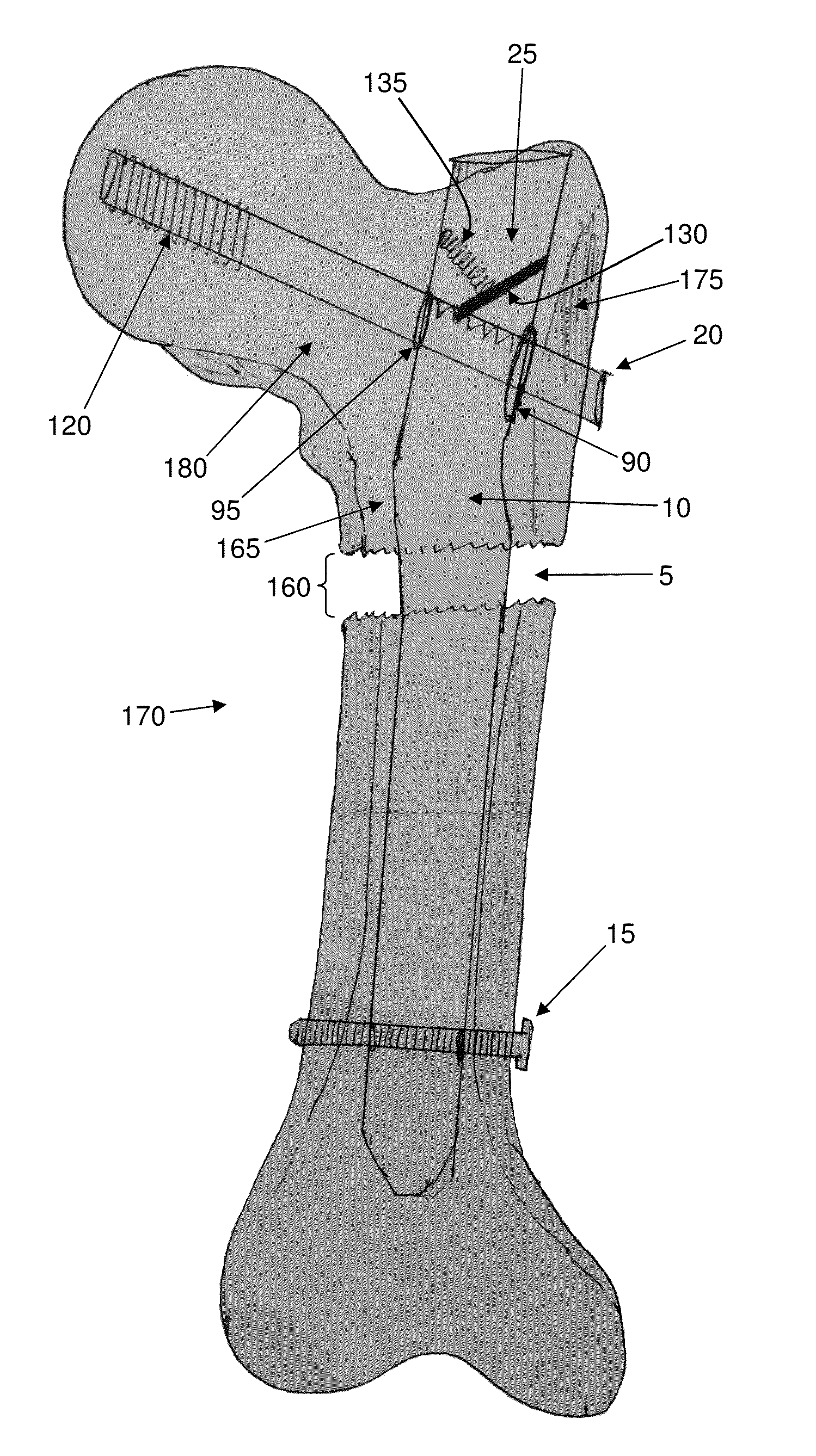 Interlocking intramedullary rod assembly for proximal femoral fractures, including unstable hip fractures