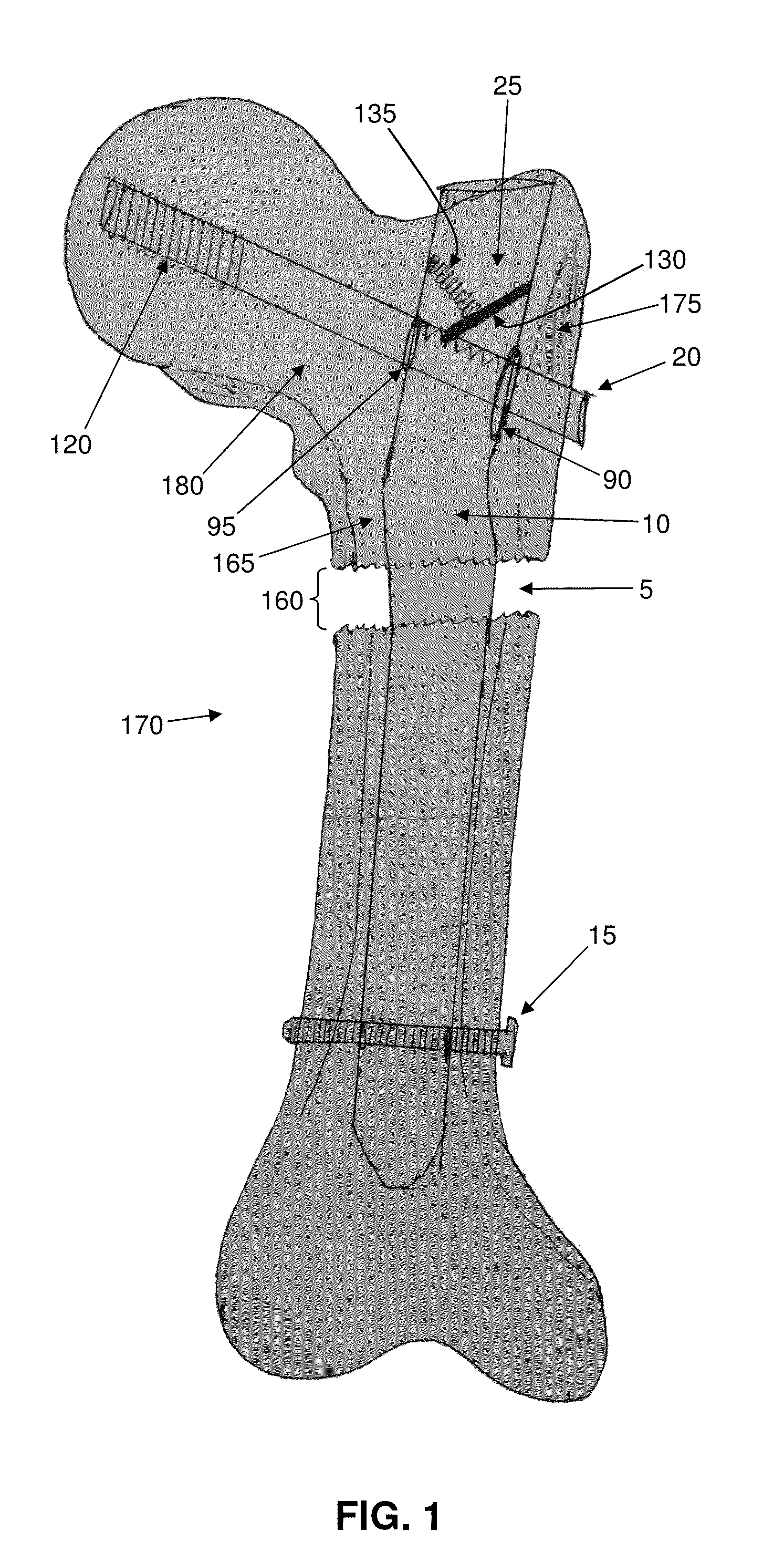 Interlocking intramedullary rod assembly for proximal femoral fractures, including unstable hip fractures