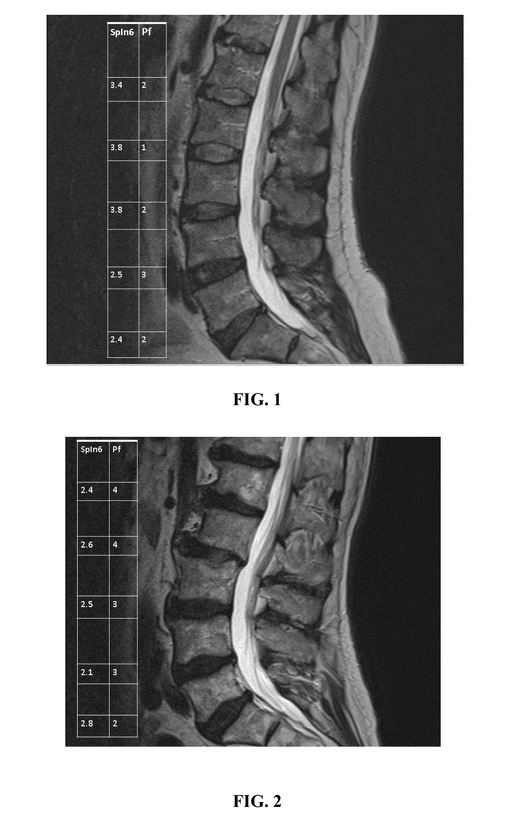 Measure of disc degeneration and pathology