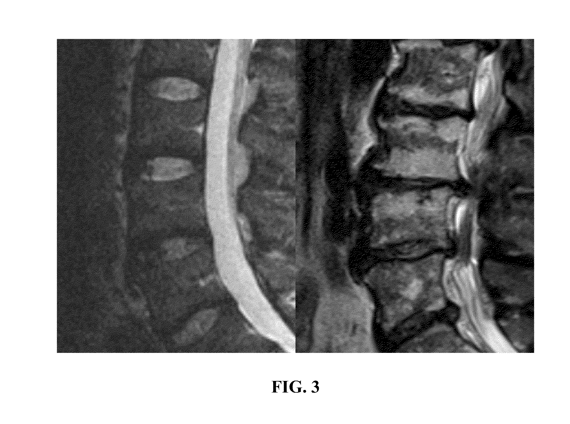 Measure of disc degeneration and pathology