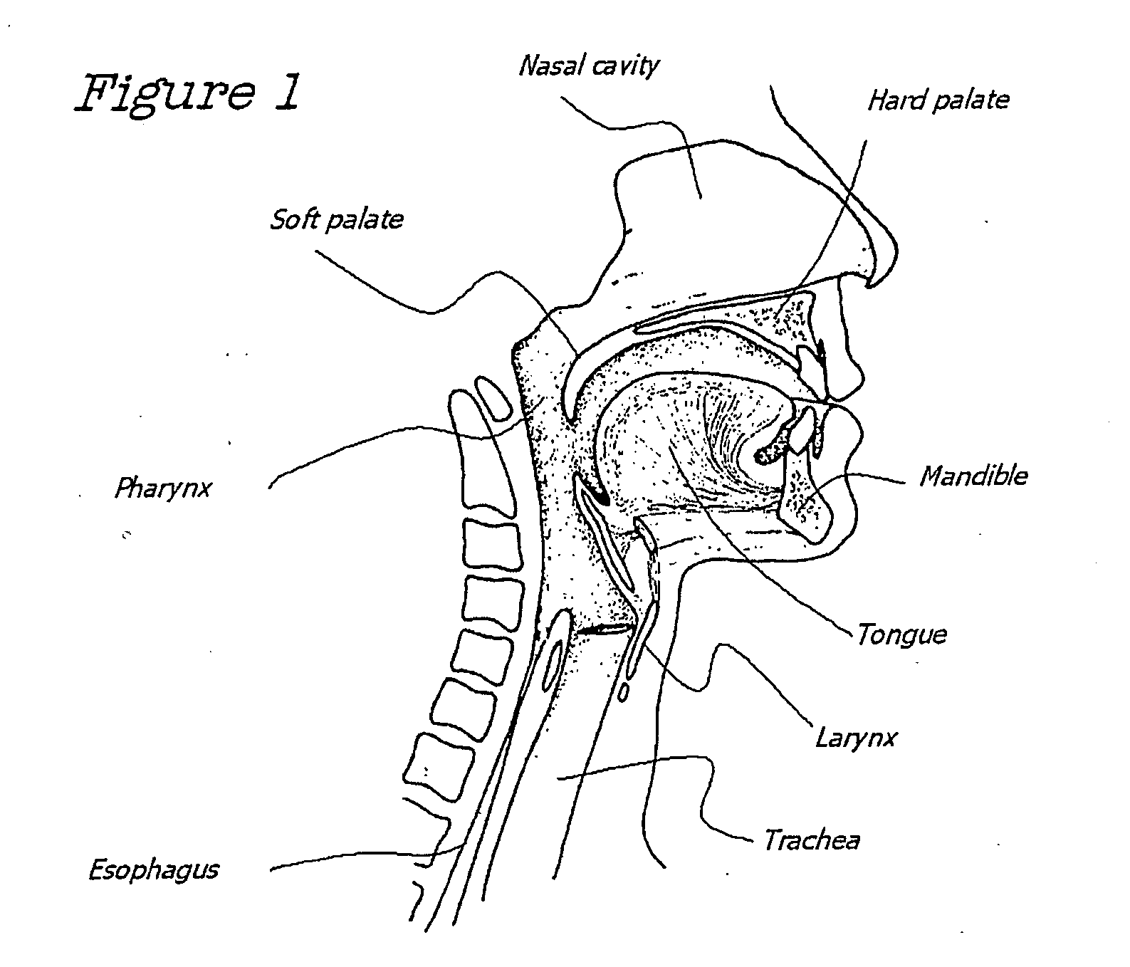 Method And Device For The Treatment Of Obstructive Sleep Apnea And Snoring