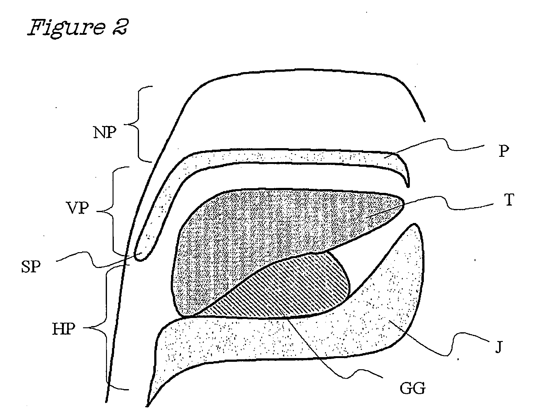 Method And Device For The Treatment Of Obstructive Sleep Apnea And Snoring