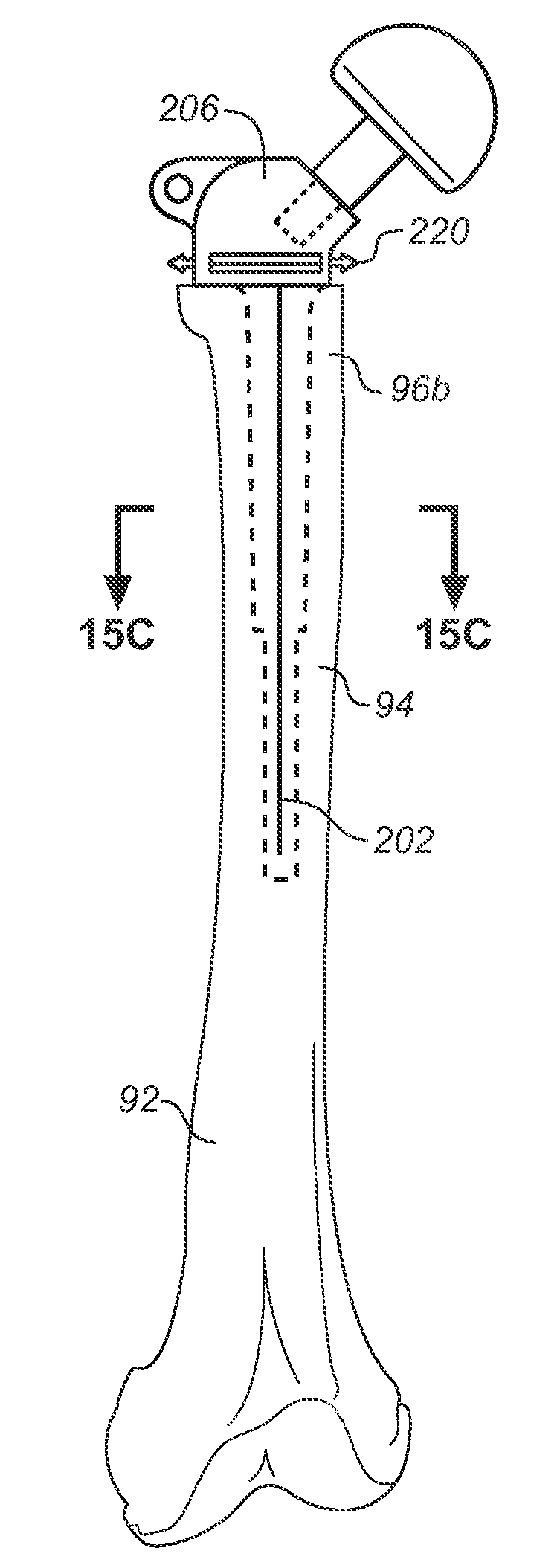 Device and method for reconstruction of osseous skeletal defects