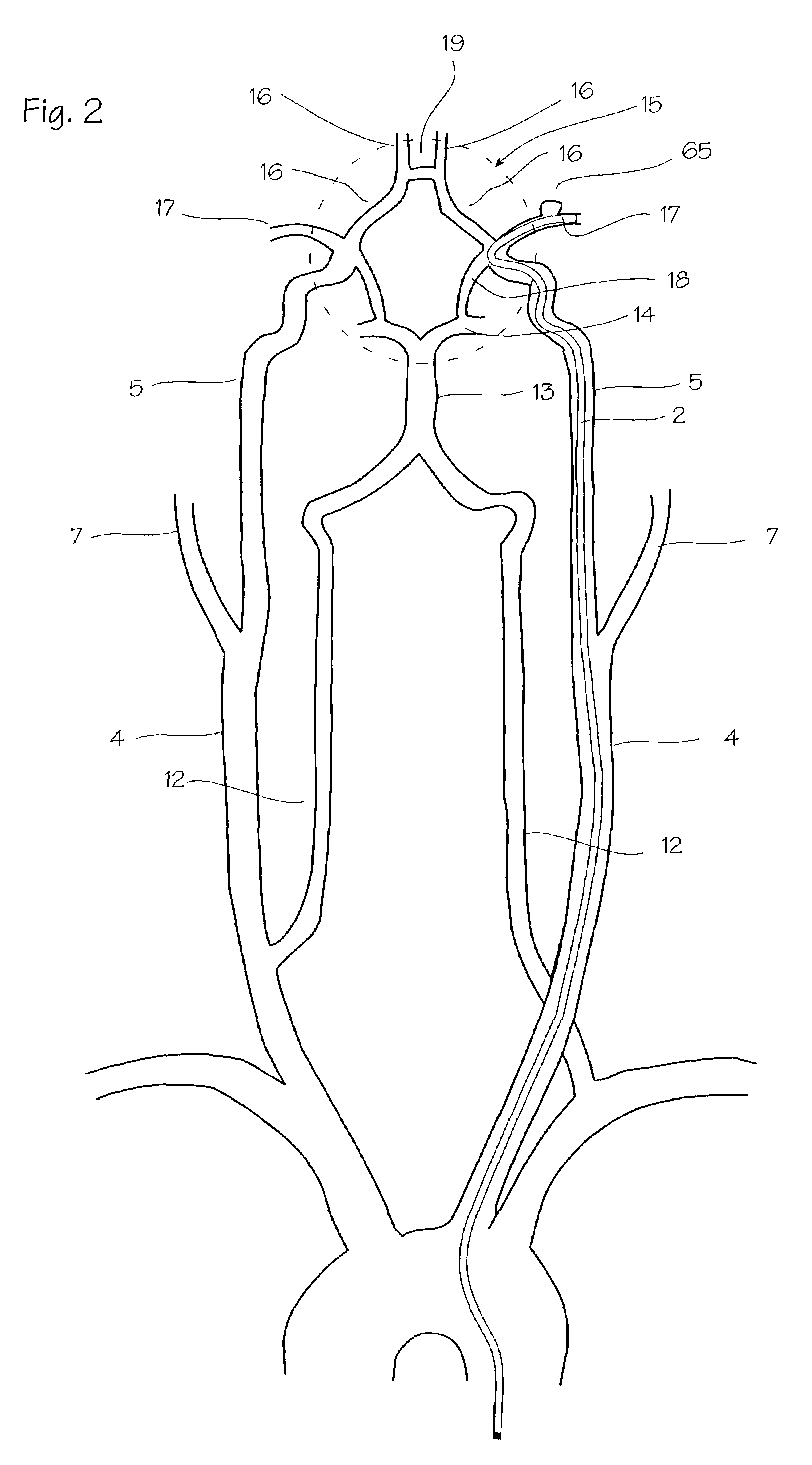 Intracranial stent and method of use