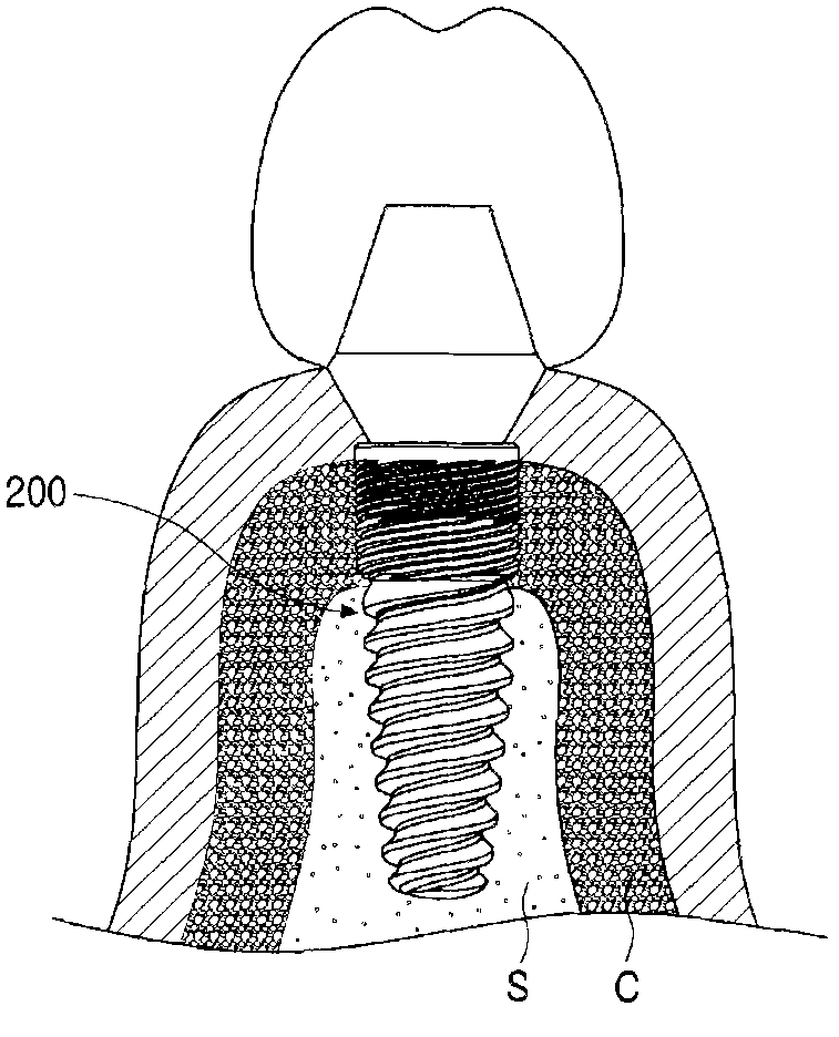 Dental implant fixture