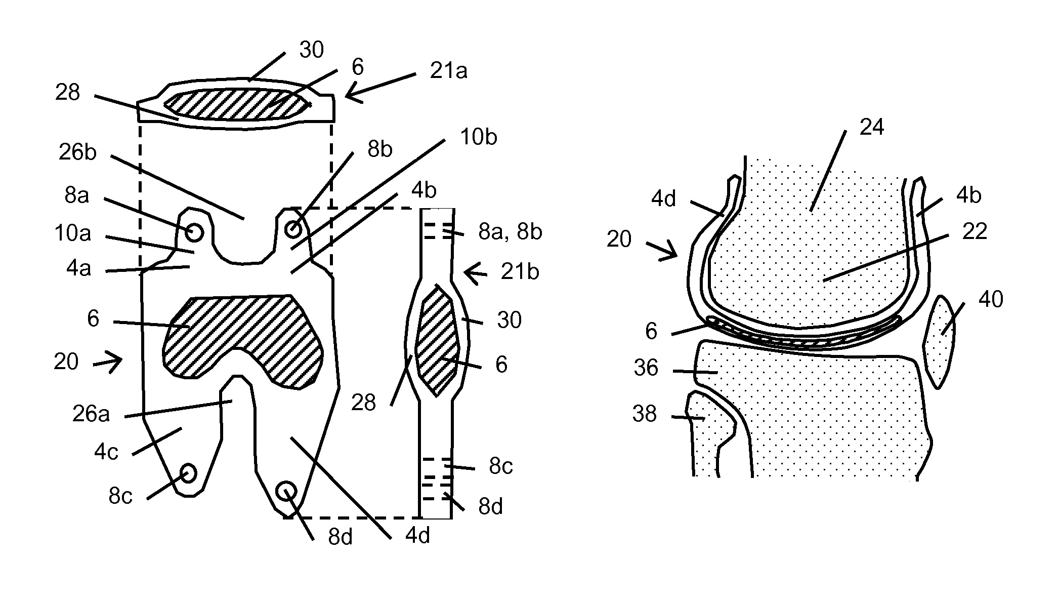 Resilient knee implant and methods