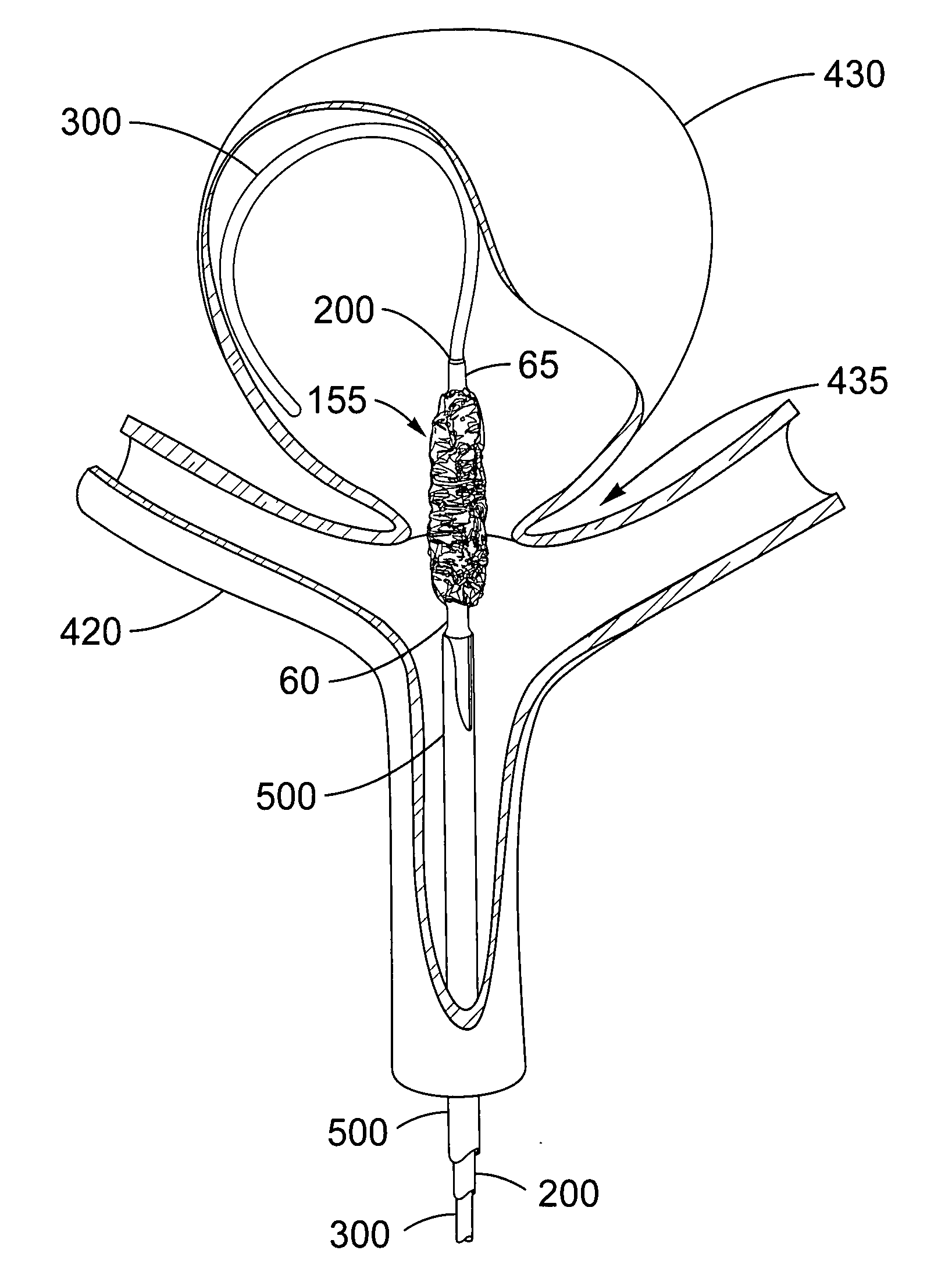 Over-the-wire exclusion device and system for delivery