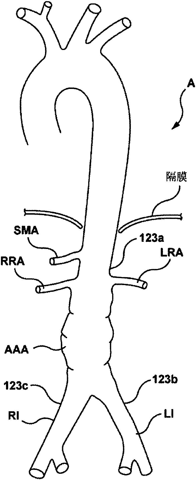 Endoluminal prosthetic devices having fluid-absorbable compositions for repair of a vascular tissue defect