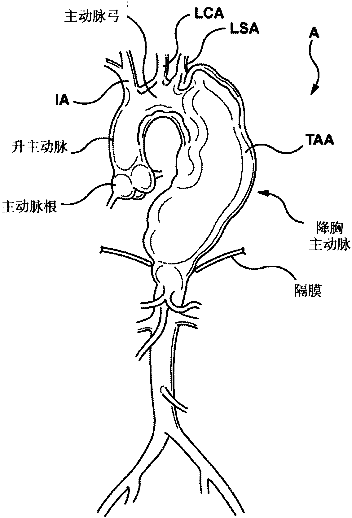 Endoluminal prosthetic devices having fluid-absorbable compositions for repair of a vascular tissue defect