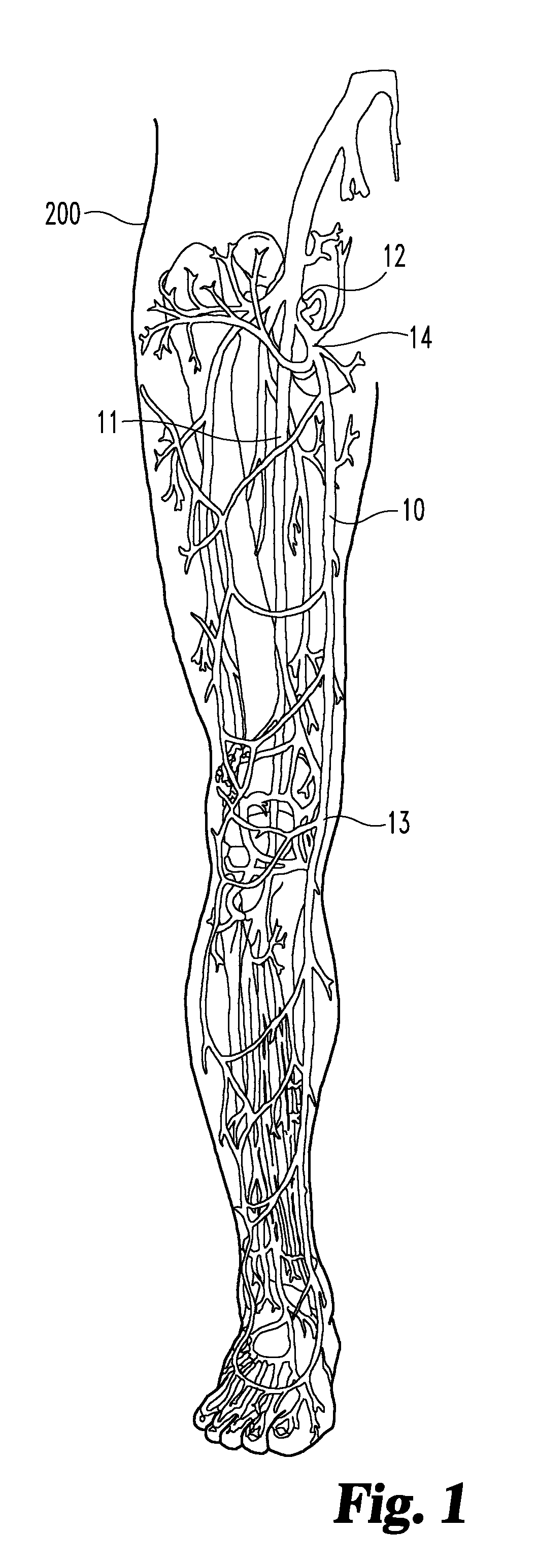 Enhanced remodelable materials for occluding bodily vessels and related methods and systems