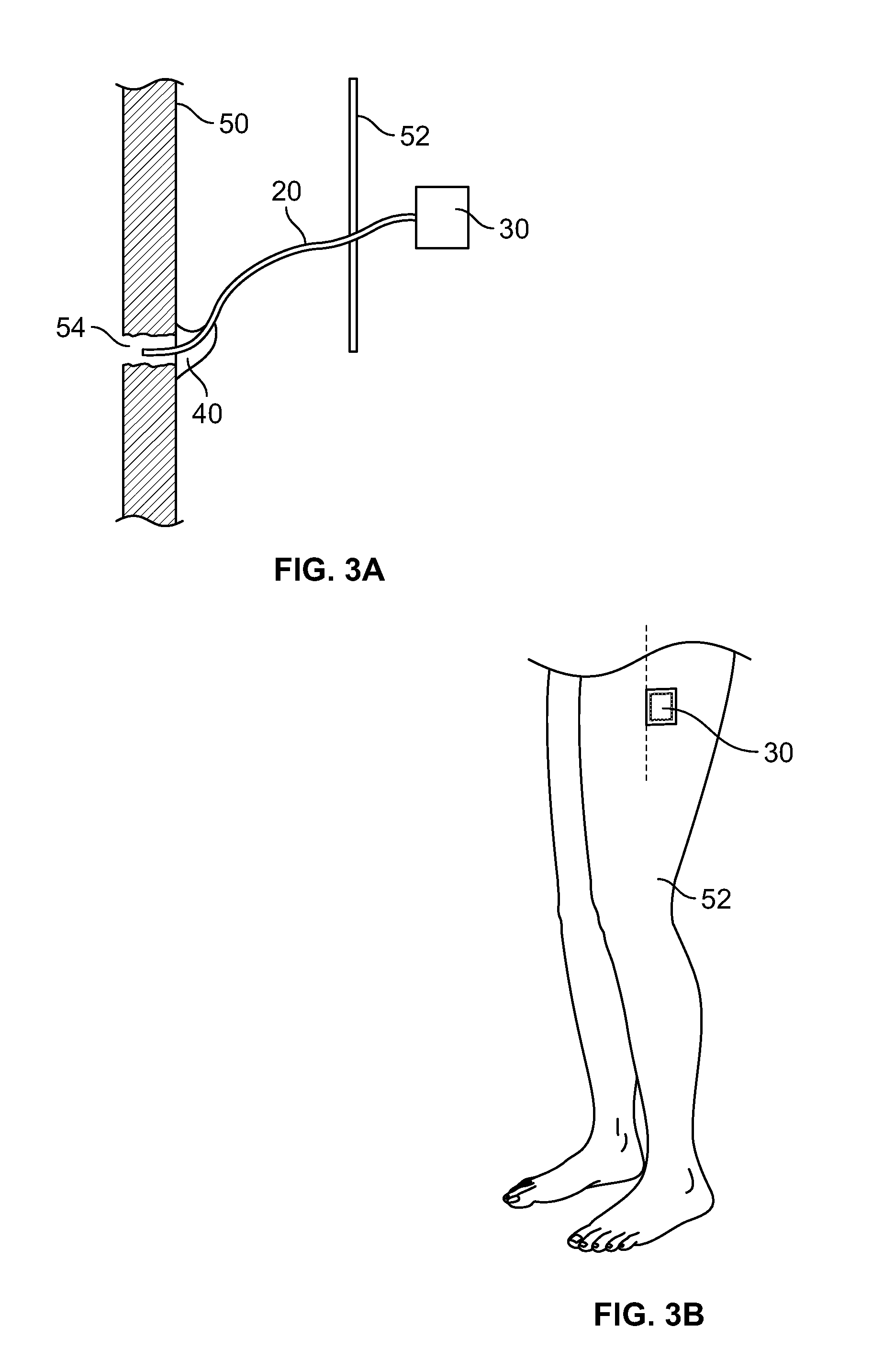 Bone healing probe