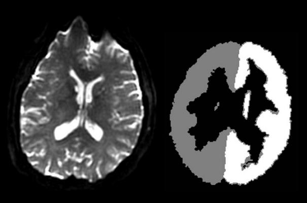 Method for automatically calculating ischemic penumbra by using ASL of brain template