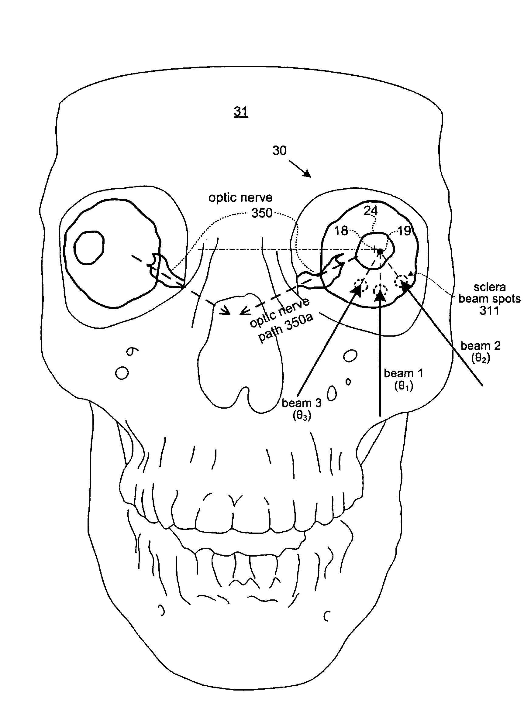 Methods and devices for orthovoltage ocular radiotherapy and treatment planning