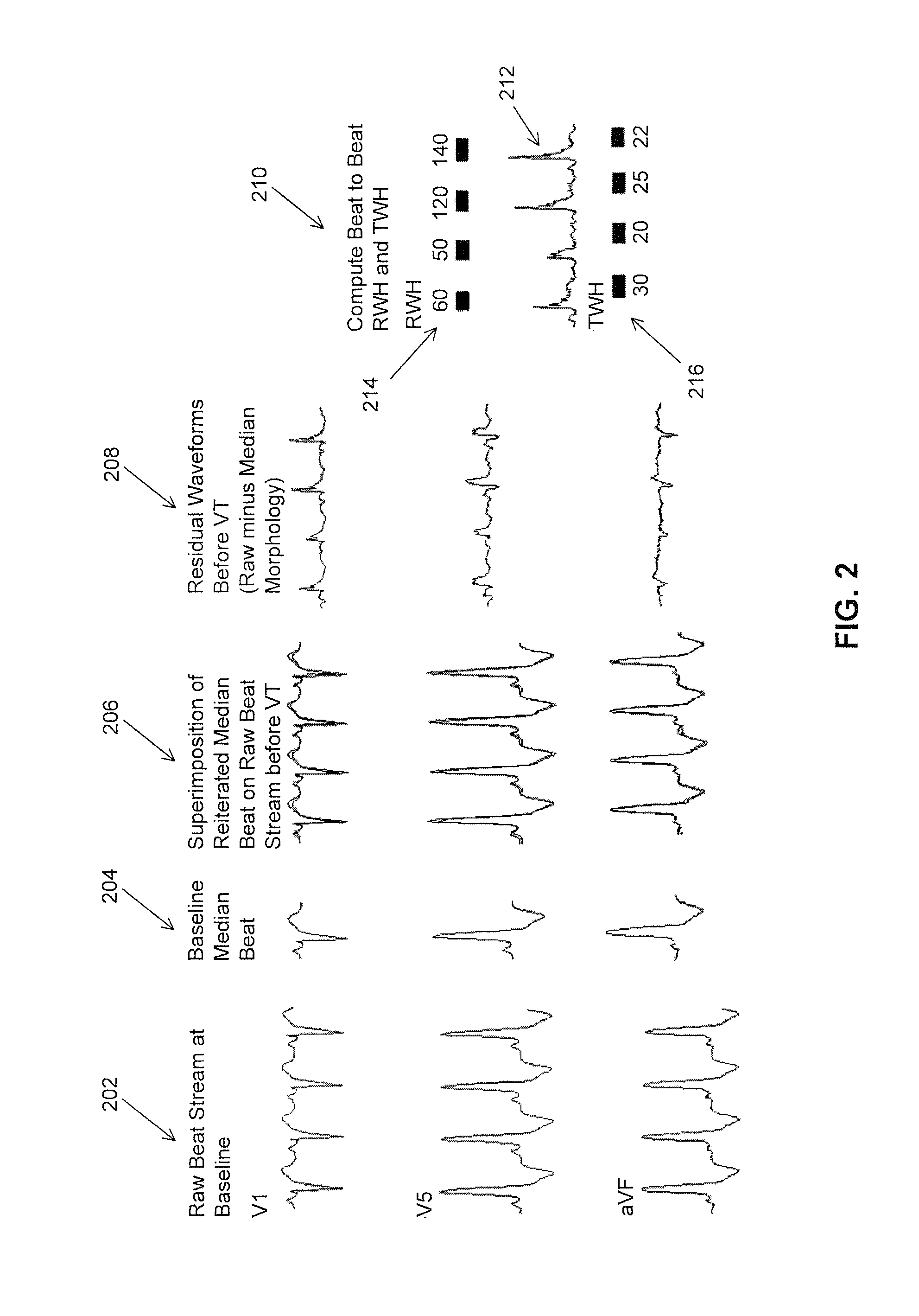 High Throughput Arrhythmia Risk Assessment Using Multilead Residua Signals