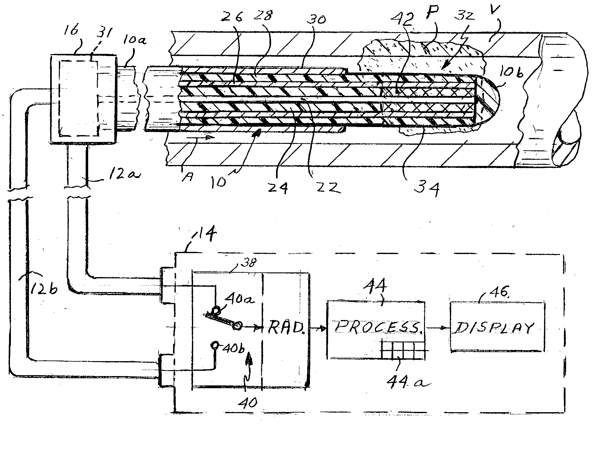 Method and apparatus for detecting and treating vulnerable plaques