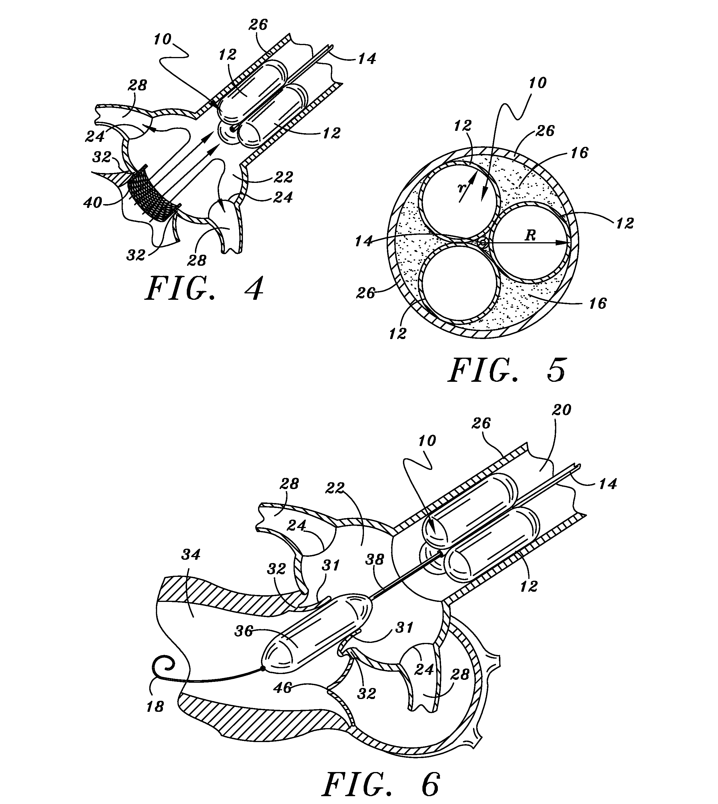 Method and Apparatus for Percutaneous Aortic Valve Replacement