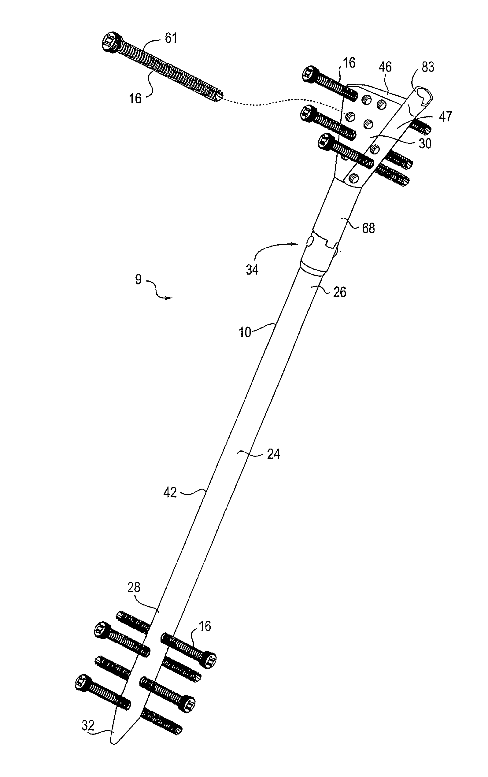 Percutaneous intramedullary bone repair device