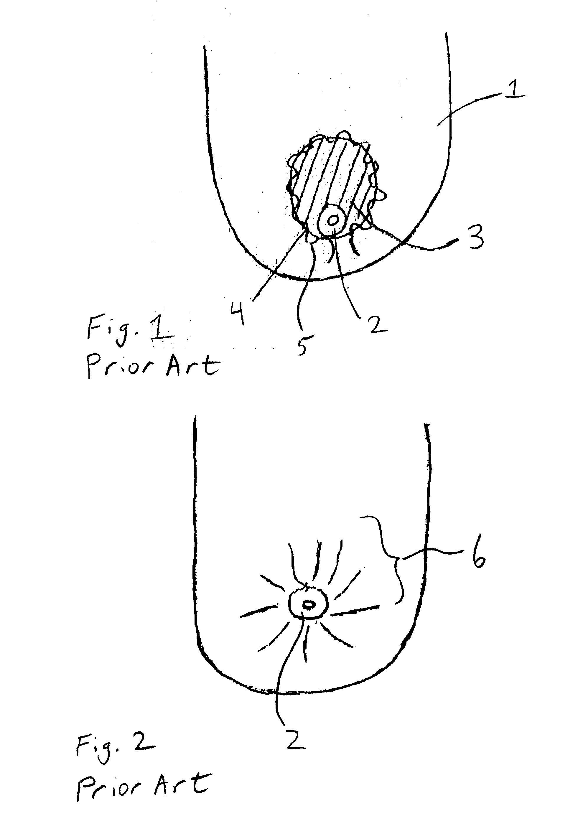 Implantable prosthesis for periareolar mastopexy