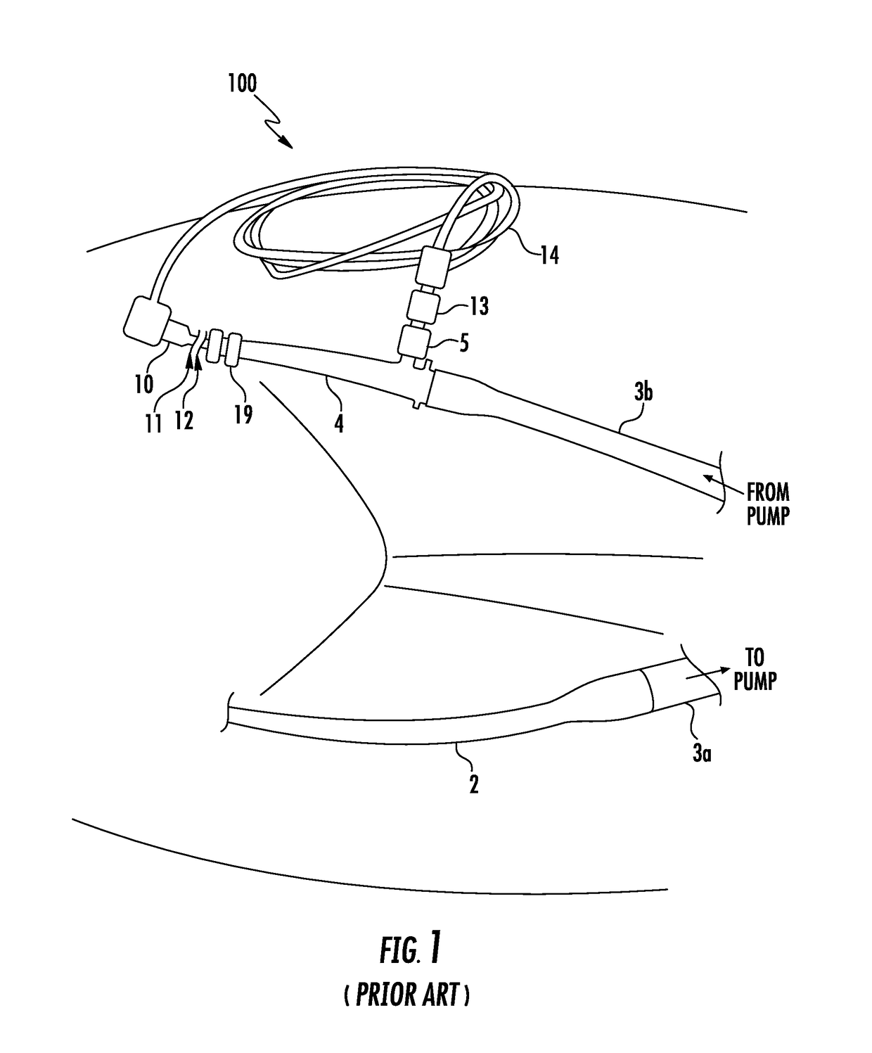 Devices for Endovascular Access Through Extracorporeal Life Support Circuits