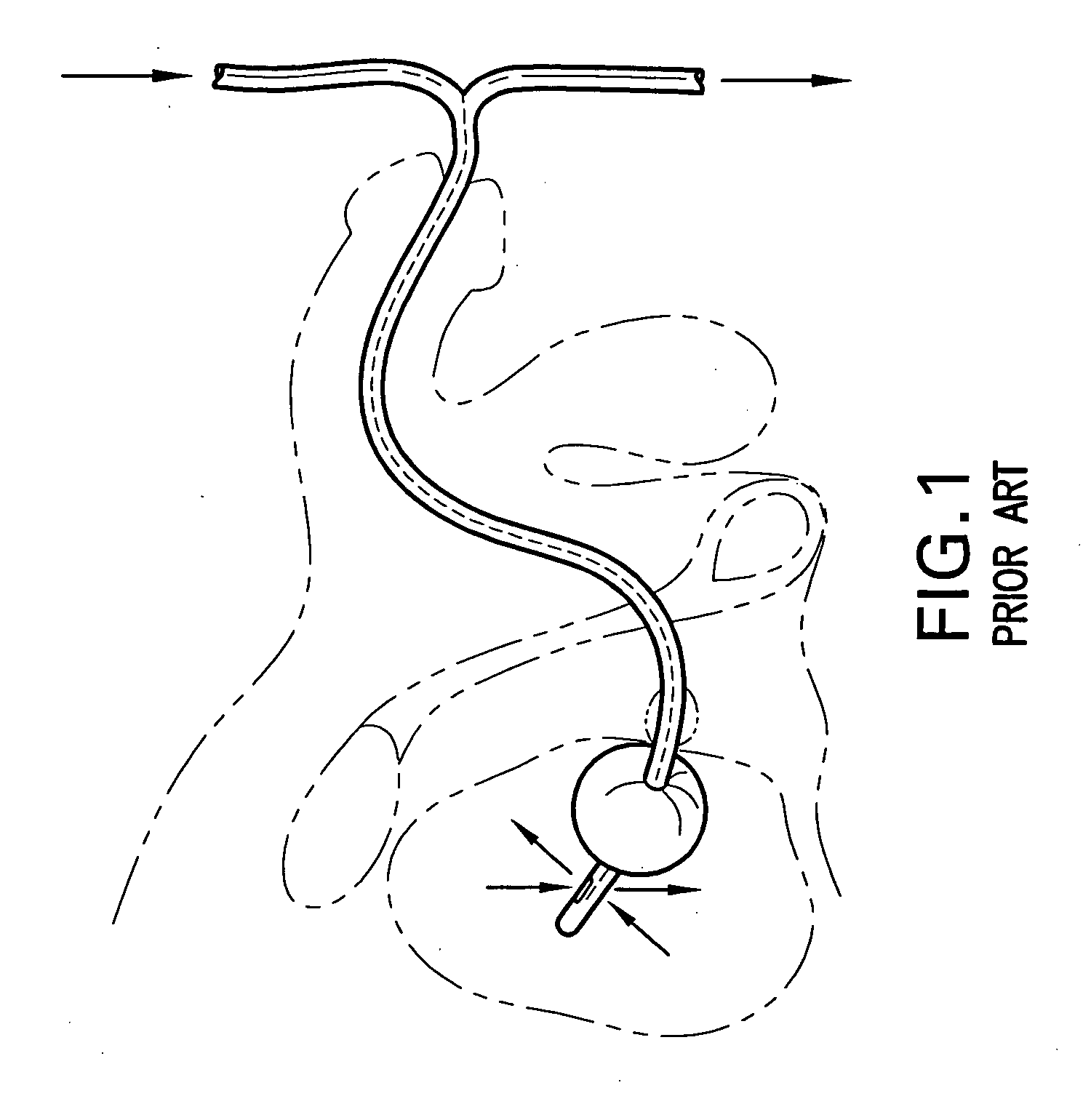 Indwelling urinary catheter