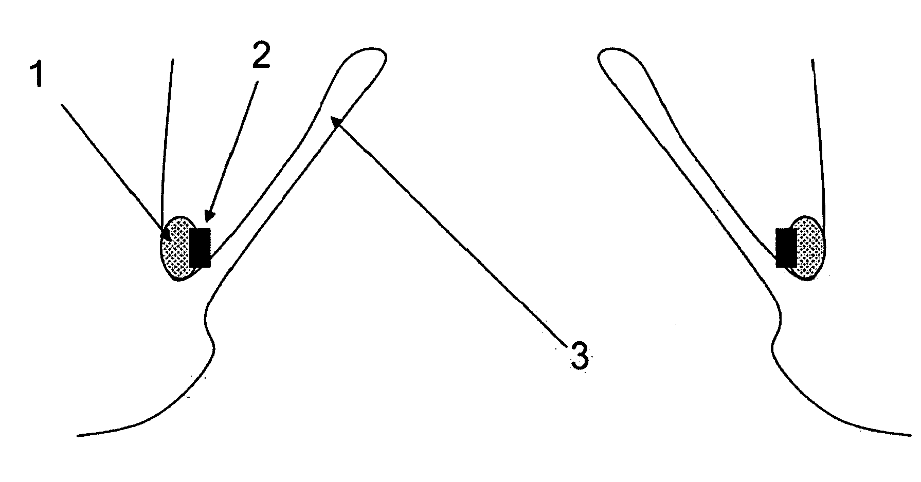 Method and apparatus for anchoring cardiovascular implants