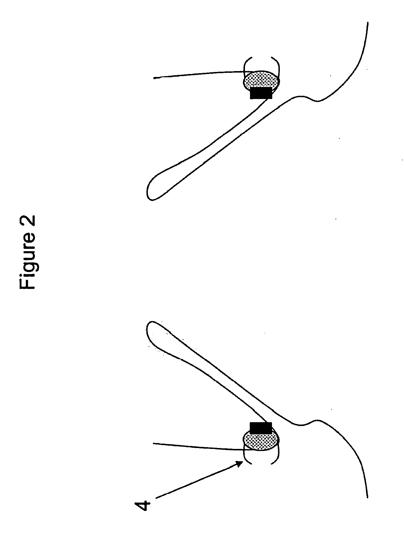 Method and apparatus for anchoring cardiovascular implants