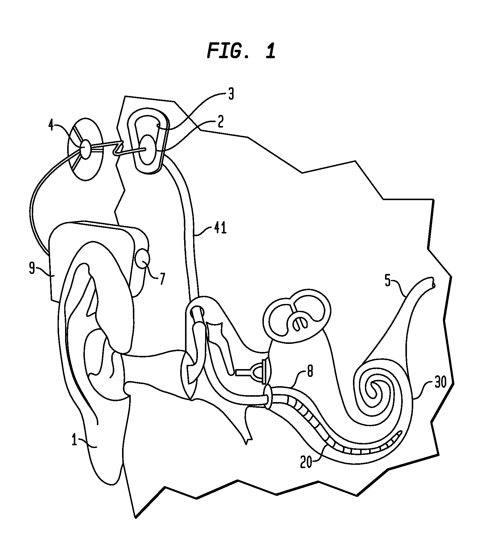 Apparatus for delivery of pharmaceuticals to the cochlea