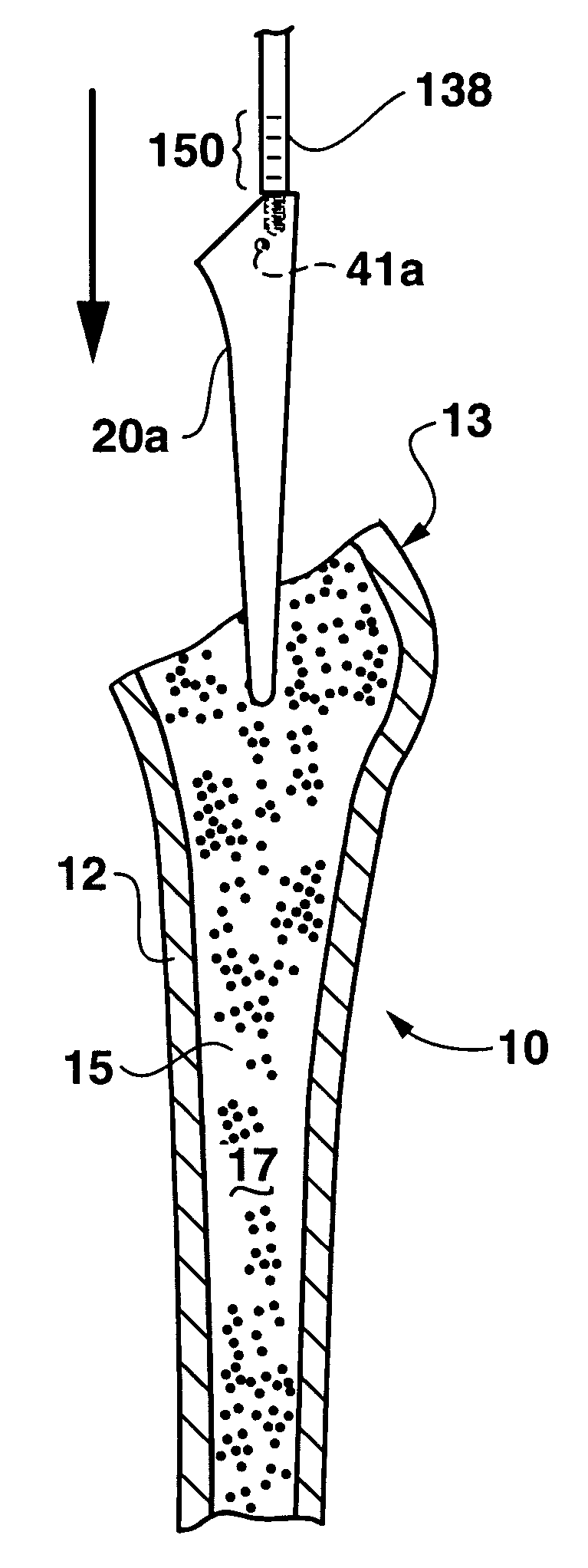 Bone preserving total hip arthroplasty using autograft