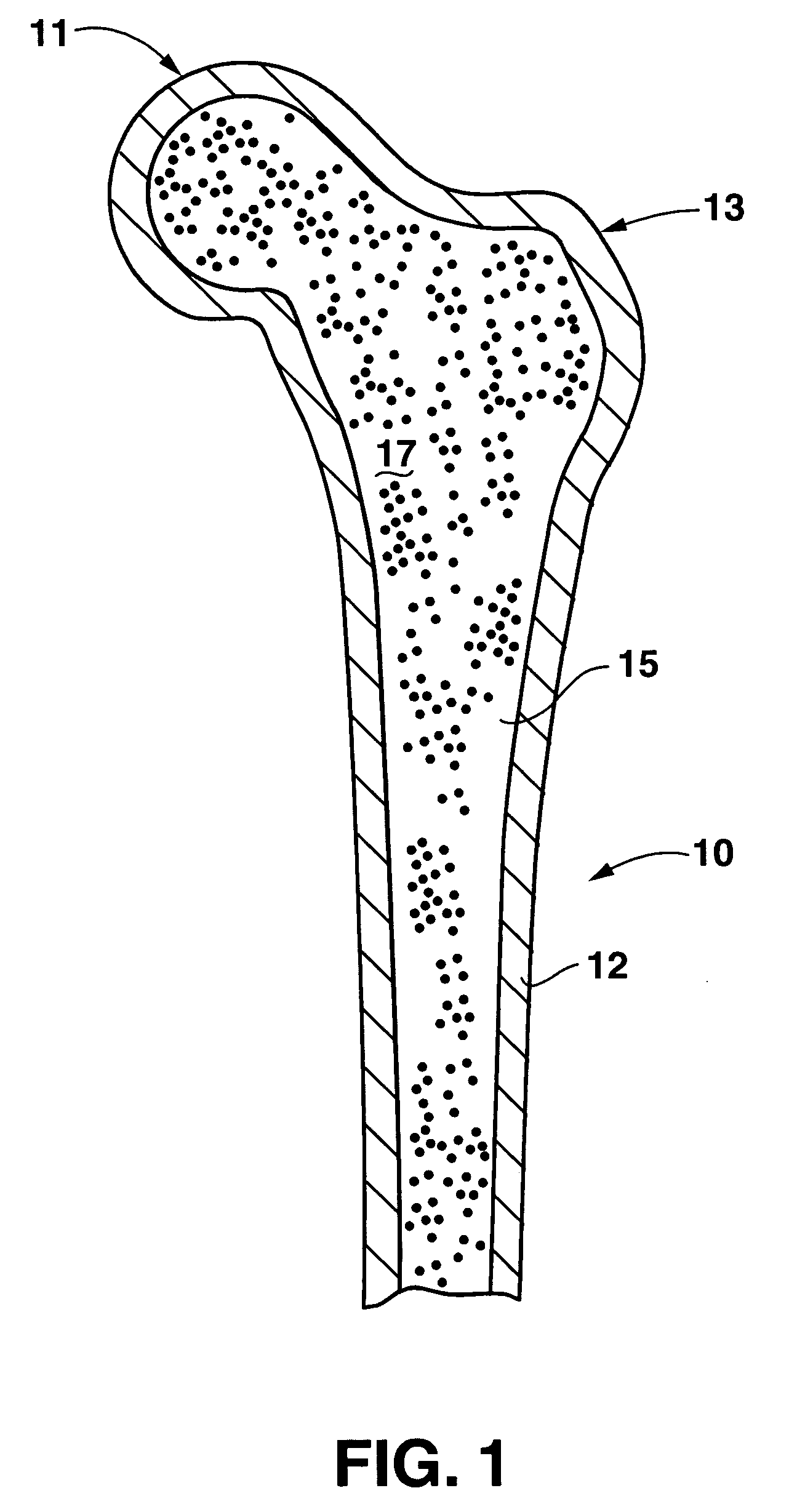 Bone preserving total hip arthroplasty using autograft