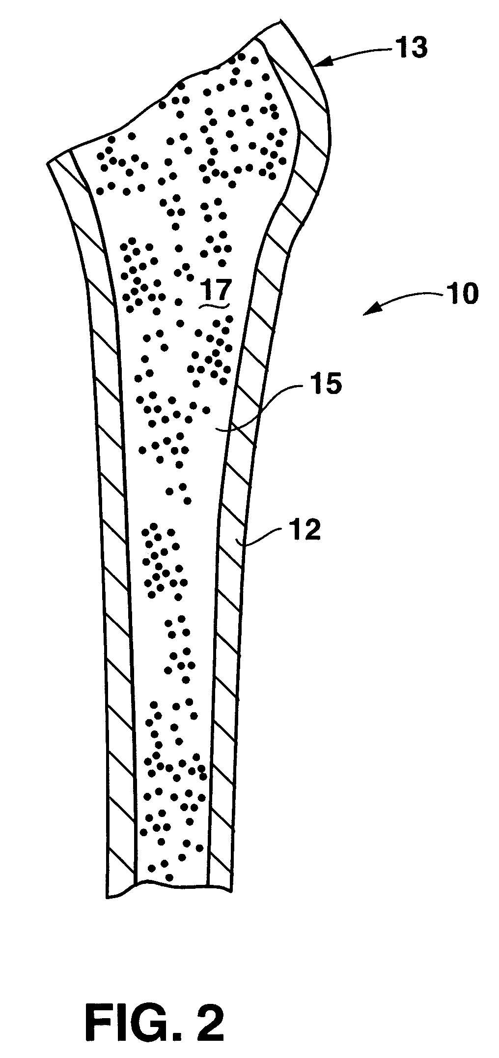 Bone preserving total hip arthroplasty using autograft