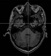 A method for measuring base bend data of goggles based on medical images