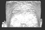 A method for measuring base bend data of goggles based on medical images