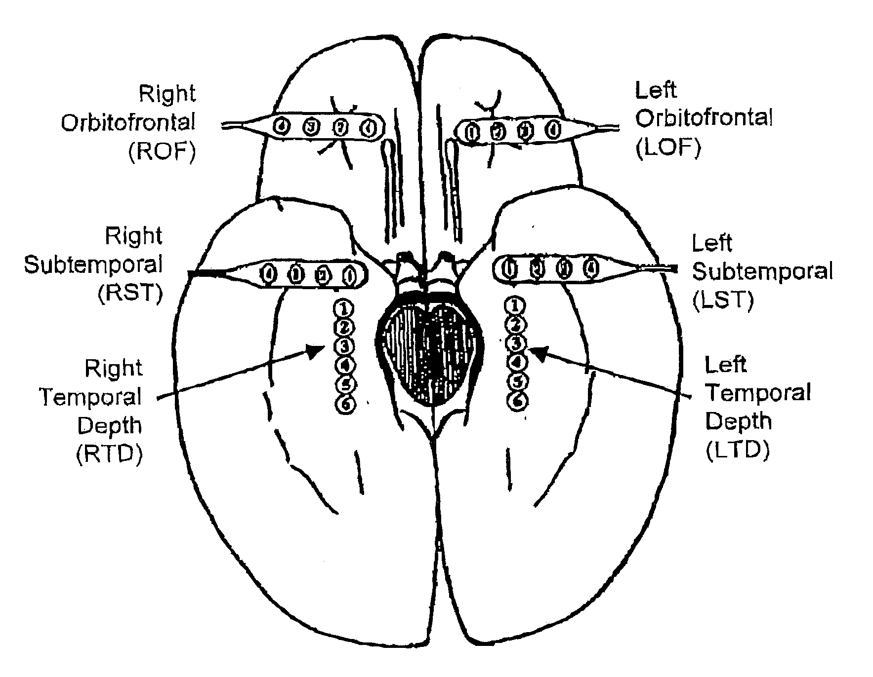 Methods for applying brain synchronization to epilepsy and other dynamical disorders