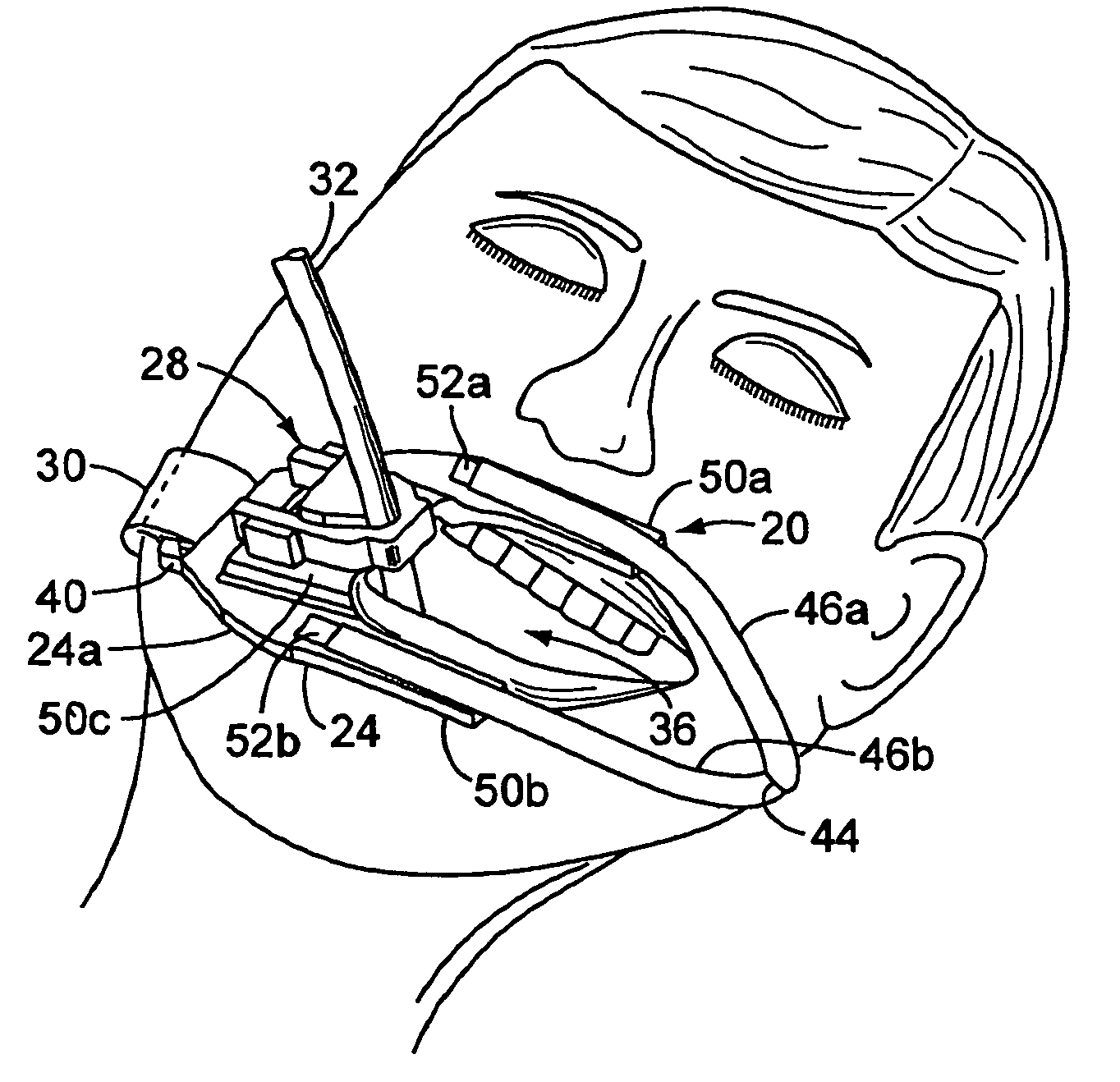 Endotracheal tube holder