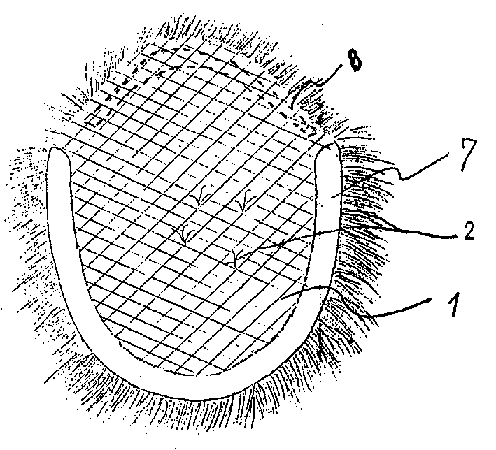 Flexible plastic bald-repairing decorative wig and its making method