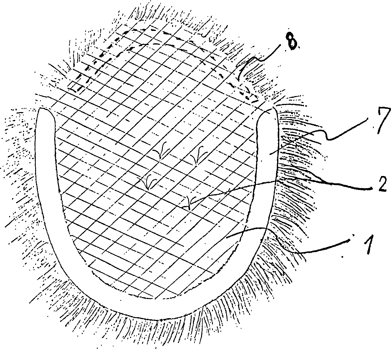 Flexible plastic bald-repairing decorative wig and its making method