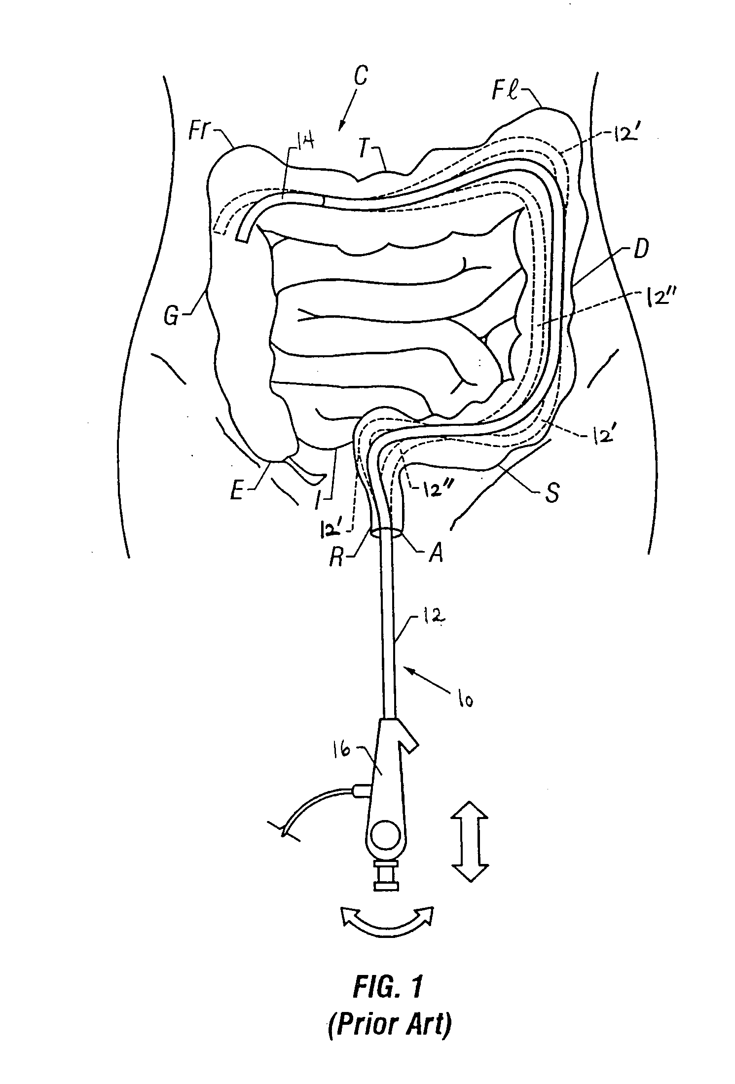 Method of navigating a therapeutic instrument with an apparatus having a handle coupled to an overtube