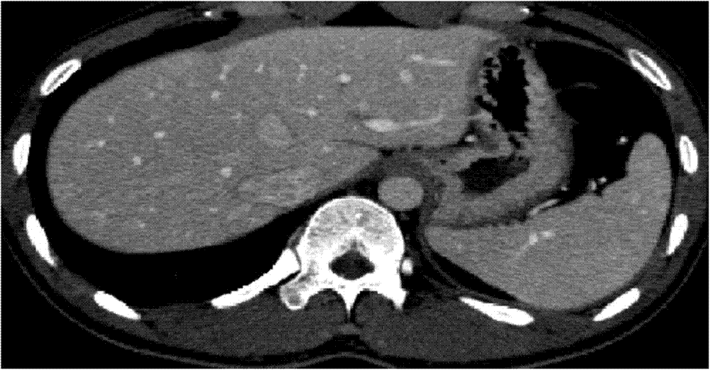 Method for simultaneously segmenting liver and blood vessel in CTA (computed tomography angiography) image