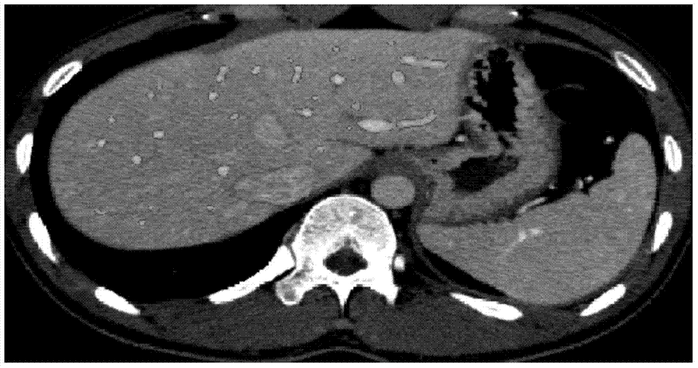 Method for simultaneously segmenting liver and blood vessel in CTA (computed tomography angiography) image