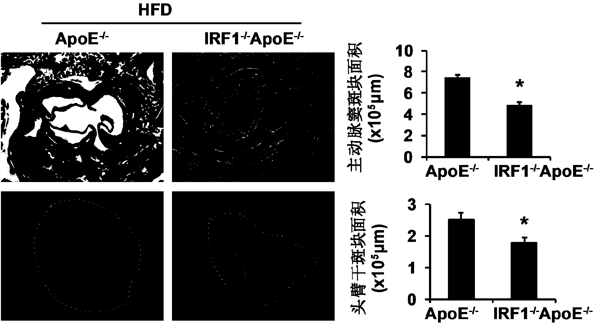 Applications of interferon regulatory factor 1 gene in treatment of atherosclerosis