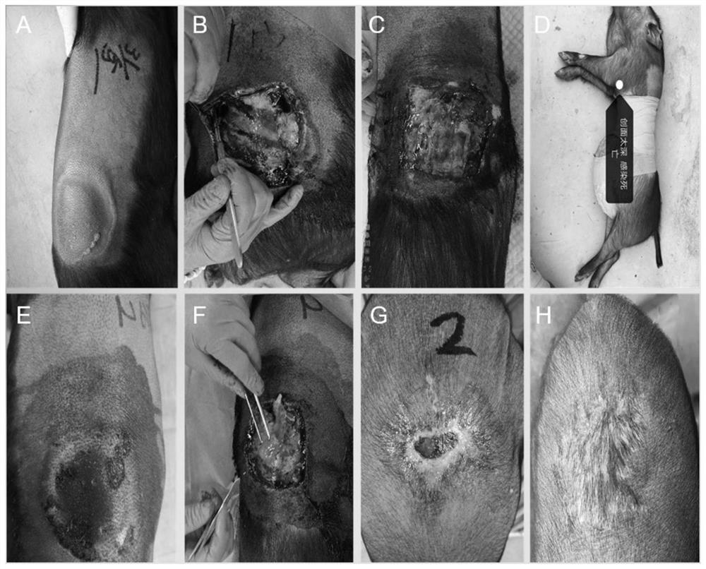 Preparation method of immunogen-removed human umbilical cord intima-fibrin composite skin scaffold