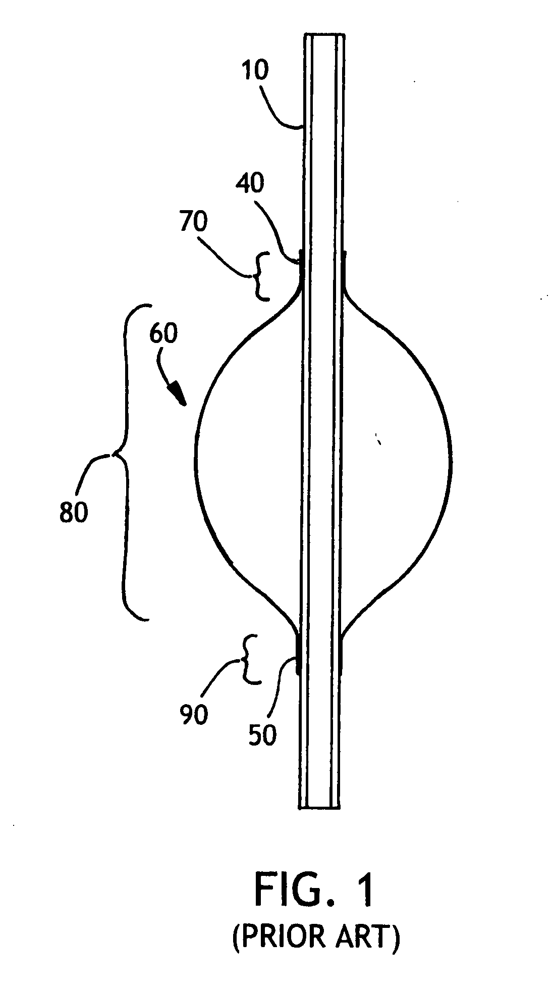 Toroidal endotracheal cuffs for ventilator associated pneumonia reduction